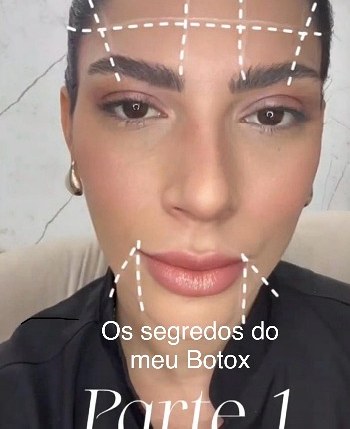 Aplicação de toxina botulínica