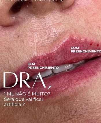 Preenchimento labial — planejamento