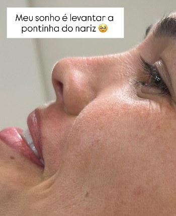 Rinomodelação — planejamento do nariz