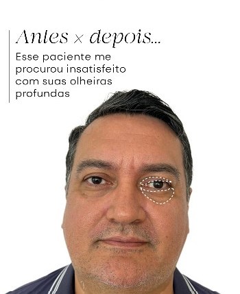 Preenchimento de olheiras