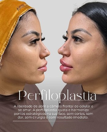 Perfiloplastia — planejamento de perfil
